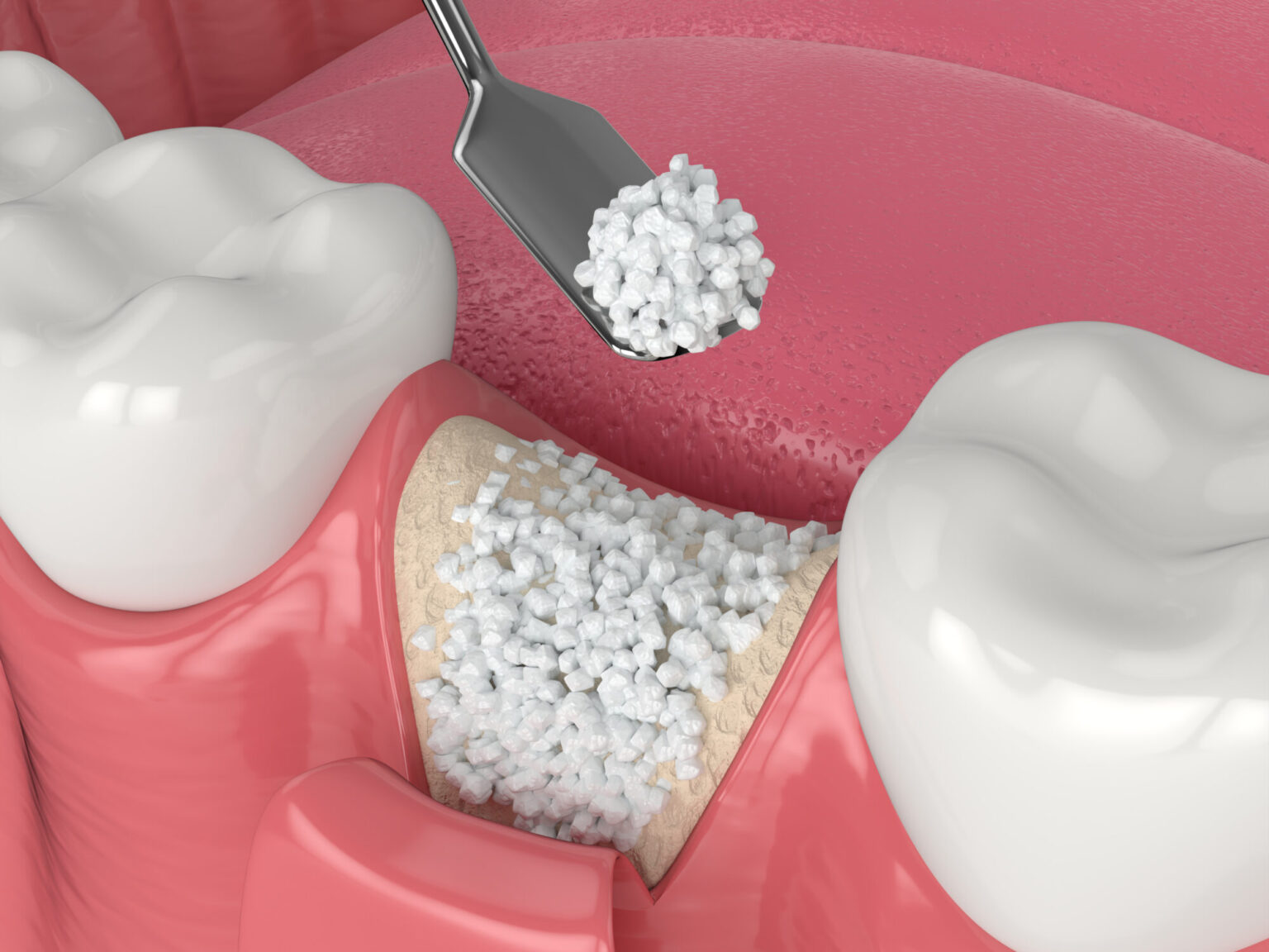 Dental Bone Grafting FAQs