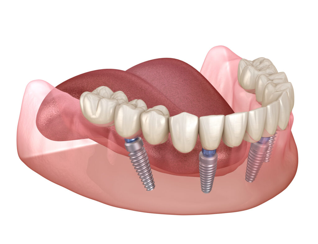 Mandibular prosthesis All on 4 system supported by implants. Medically accurate 3D illustration of human teeth and dentures concept