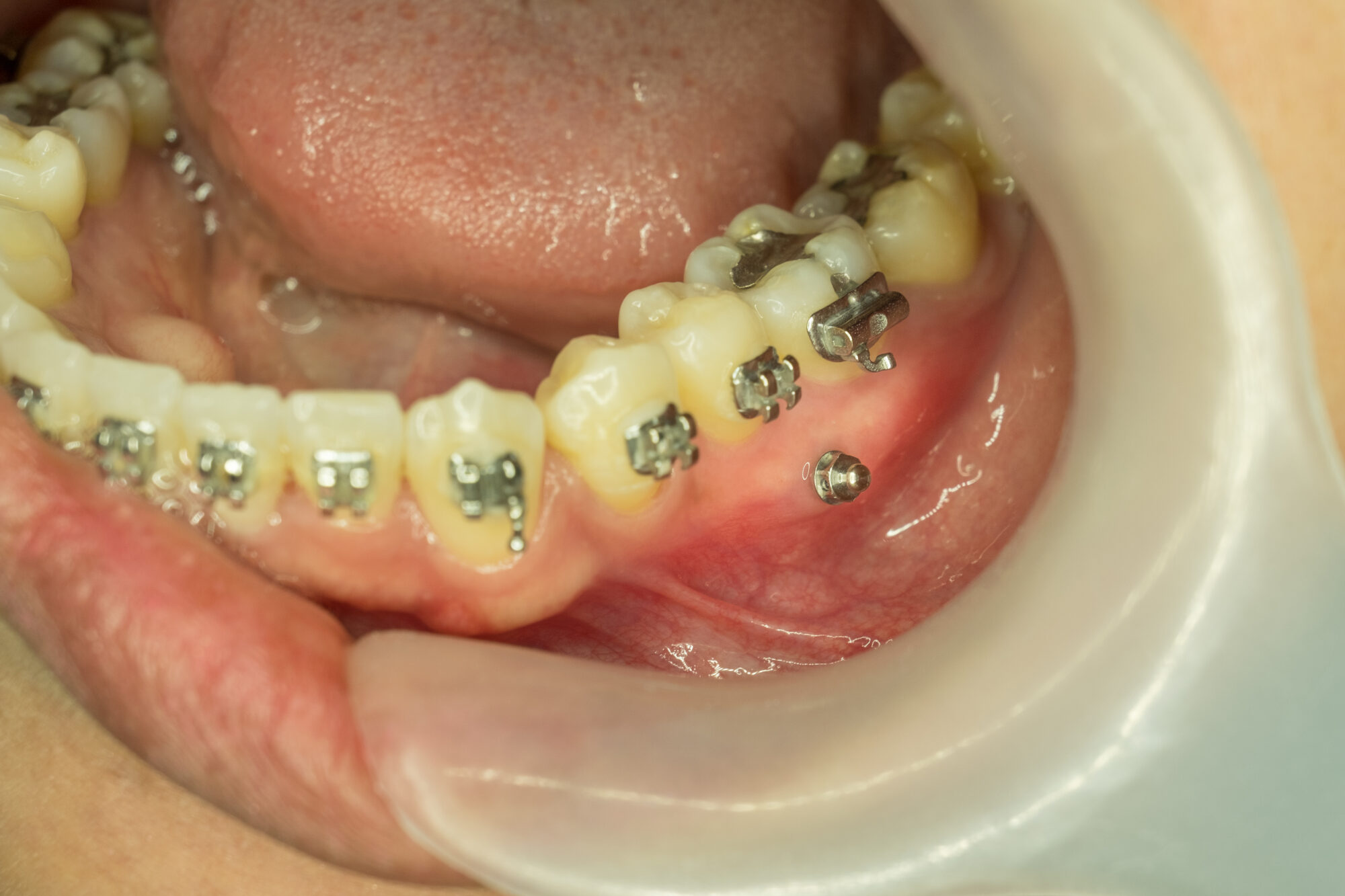 miniscrew in orthodontic treatment